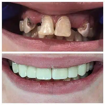 Before After 2