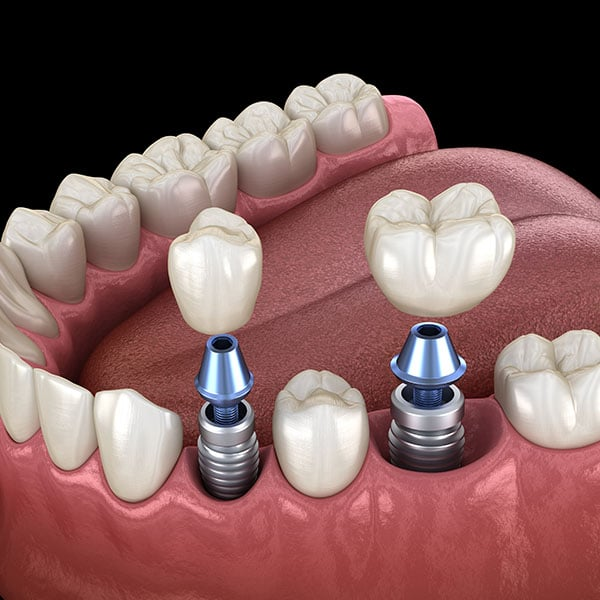 Implant