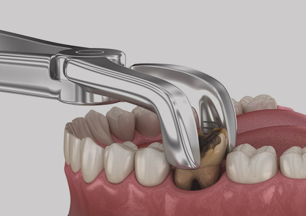 Decayed Teeth Removal