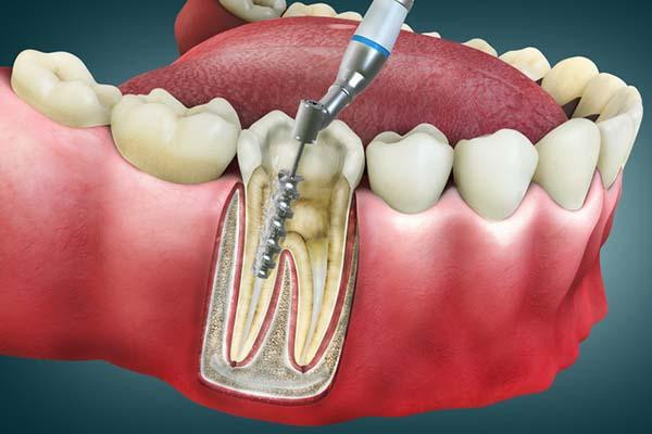 Root Canal Therapy